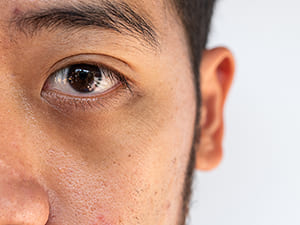 ده درمان خانگی برای از بین بردن سیاهی دور چشم