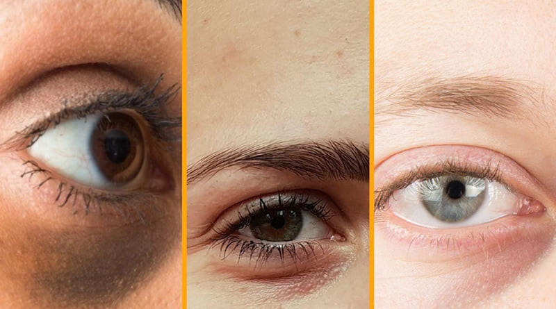 ده درمان خانگی برای از بین بردن سیاهی دور چشم