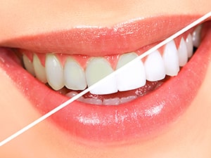 6 روش طبیعی برای سفید کردن دندان‌ها