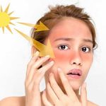 درمان های خانگی ساده برای آفتاب سوختگی