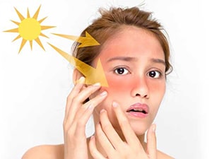 درمان های خانگی ساده برای آفتاب سوختگی